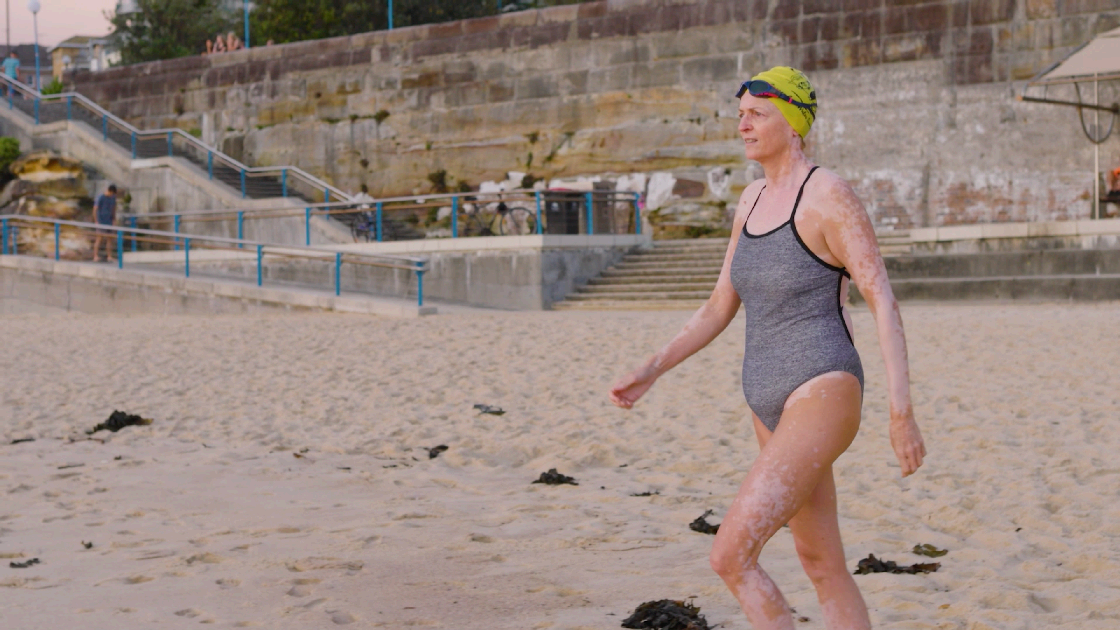 Anne Gately Beach Swim Vitiligo Conquering Skin Cancer - Conquering Cancer Campaign